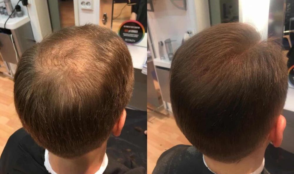 Parykk  en praktisk og trygg løsning ved hårtap